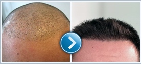 Hair transplant